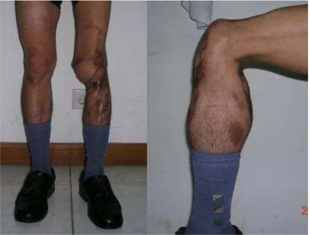 Figure 4. There was no local recurrence and range of movement of the knee was 0-90° at ifteen month follow-up
