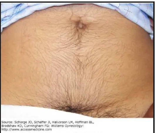 Gambar 1. Hirsutisme 9 