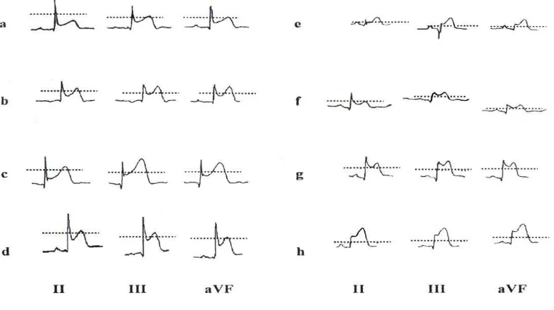 Figure 1. QRS distortion in inferior leads. Negative QRS distortion defined as ratio J-point/R wave < 50% ( a,b,c,d)