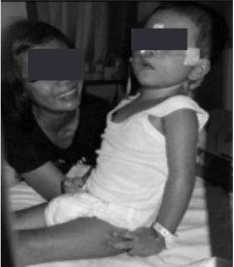 Figure 1. Posture of a child with spastic diplegia cerebral palsy