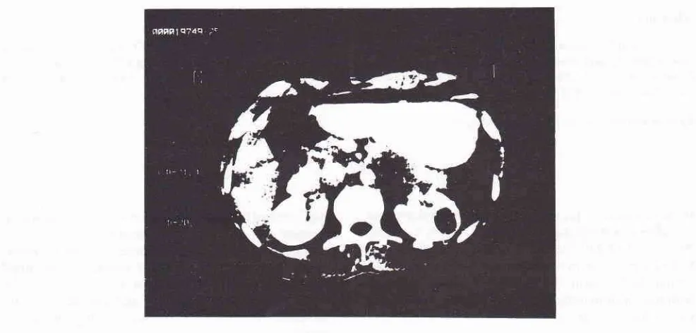 Figure l. CT abdomen showing well definedfluidfilled cyst in left kidney 2.0 X 2.1 cm.