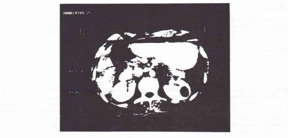 Figure l. CT abdomen showing well definedfluidfilled cyst in left kidney 2.0 X 2.1 cm.