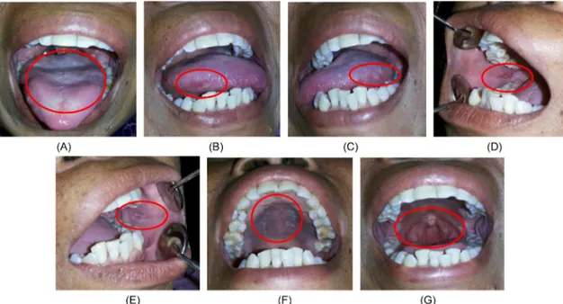 Gambar 2. Gambaran	klinis	intra	oral	setelah	satu	minggu	pengobatan.	(A,	B,	C)	Plak	putih	pada	lateral	dan	dorsal	lidah	 menipis.	(D,	E)	Ulser	pada	mukosa	bukal	kanan	dan	kiri	tampak	mengecil.	(F)	Plak	putih	tebal	berkurang	pada	palatum	 durum	dan	molle.	(