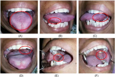 Gambar 3. Gambaran	klinis	intra	oral	pada	kunjungan	terakhir.	(A,	B,	C)	Plak	putih	pada	 dorsal	lidah,	lateral	lidah	semakin	menipis.	(D,	E,	F)	Plak	putih	pada	palatum	durum	dan	 molle	semakin	menipis,	serta	ulser	pada	mukosa	bukal	kanan	dan	kiri,	dan	tons