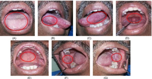 Gambar 5. Perbaikan	kondisi	intra	oral	pasien	kedua	setelah	satu	minggu	pengobatan.	(A,	B,	C)	Plak	putih	dan	eritema	 pada	lateral	dan	dorsal	lidah	menipis	dan	area	eritema	berkurang.	(D,	E,	F,	G)	Lesi	erosif	mengecil	dan	plak	putih	menipis	 pada	palatum,	