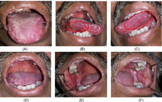 Gambar  6.  Gambaran	 klinis	 intra	 oral	 pasien	 pada	 kunjungan	 ketiga,	 21	 hari	 setelah	 pengobatan.	 (A)	 Plak	 putih	 tebal	 tampak	 menutupi	 permukaan	 dorsal	 lidah.	 (B,	 C)	Area	 eritema	 dan	 plak	 putih	 disekitarnya	tampak	muncul	lagi	dise