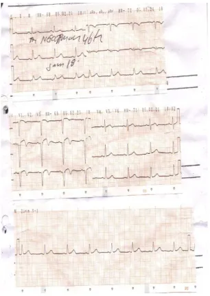 Figure 1. ECG showing ST segment elevation in V1-V3, T wave inverted in aVL, V1-V4, QS wave in V1-V3 