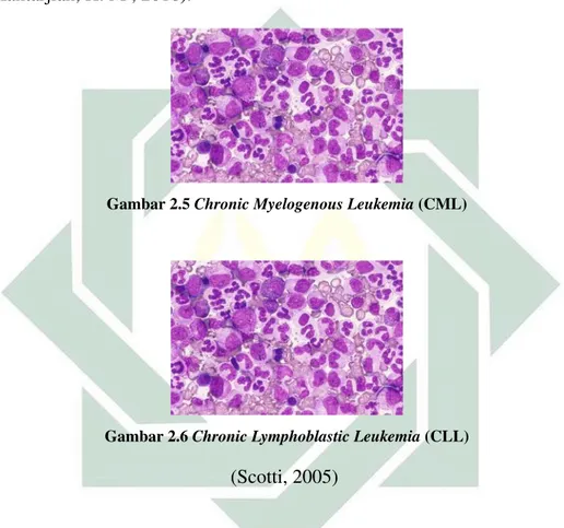 Gambar 2.5 Chronic Myelogenous Leukemia (CML)
