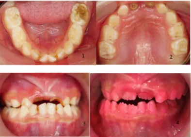 Gambar 1. Intra Oral Pasien (1-3), Pemeriksaan OHI dengan skor 3 Pasien pada Awal Kunjungan ke RSGM  UNPAD Menunjukkan Indeks Plak yang buruk (4)