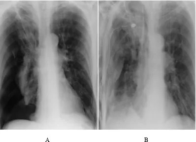 Figure 1. A) Right sided pneumothorax with a slight mediastinal shift, B) post-tubing state