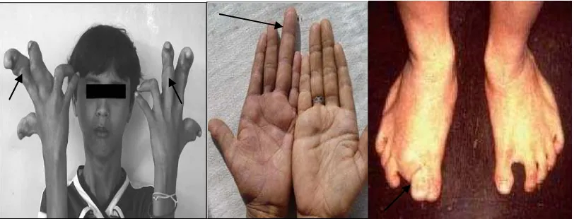 Gambar 10. Macrodactyly pada jari tangan dan jari kaki.9,10,11 