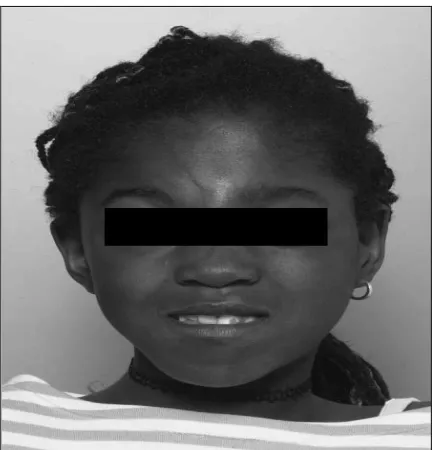 Gambar 13. Pasien berumur 20 tahun terlihat jelas adanya hemifacial hypertrophy pada wajah.3 