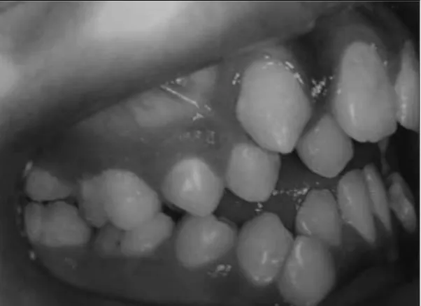 Gambar 19 . Gambaran intraoral menunjukkan adanya gigi hipoplasia,                       open bite anterior disertai dengan hyperplasia gingival.12 