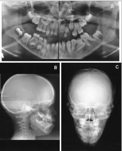 Gambar 21. (A) Orthopantogram, (B) lateral, (C) radiografi sefalometri frontal pada anak perempuan   