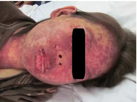 Figure 1. Multiple maculopurpura lesions on face