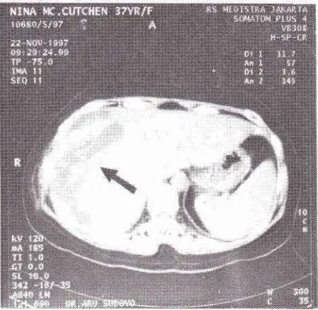 Figure 1. This CT-scan showed a large sub-capsularhematoma (arrow) on the subphrenic right lobe of the liver.The liver was torn horizontally rather vertically.
