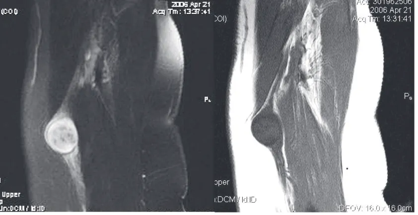 Figure 1. T1 with contrast (left) and T2 (right) MRI of left arm, showing left median nerve Schwannoma also showing the course of the median nerve.