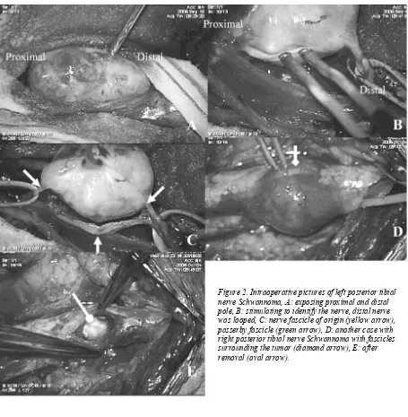 Figure 2. Intraoperative pictures of left posterior tibial 