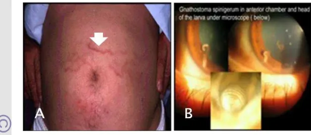 Gambar 4 Gejala klinis gnathostomiasis manusia 