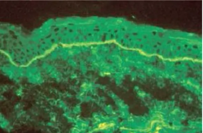 Gambar  14.  Imunofluoresen  langsung  kulit  perilesional  (normal  appearing)menampakkan deposit C3 linear continuous dalam epidermal basement membrane