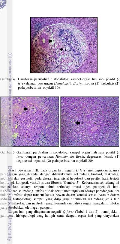 Gambar 4 Gambaran perubahan histopatologi sampel organ hati sapi positif Q 