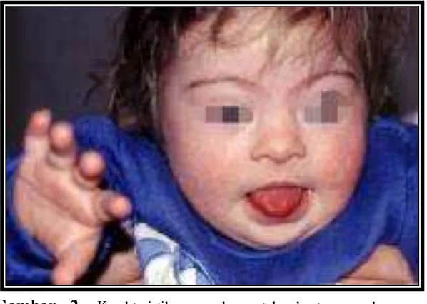 Gambar 2. Karakteristik permukaan telapak tangan dengan hypertelorism, batang hidung yang pesek, lidah yg protrusi, satu garis simian palmar pada anak perempuan  Sindroma Down umur 2 tahun (L.Dourmishev, MD,PhD,DSc :Down Syndrome.2009: 2) 