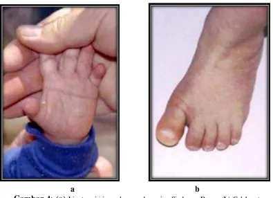 Gambar 4: (a) Lipatan simian palmar pada pasien Sindroma Down. (b) Celah antara  jari kaki yg pertama dengan  jari kaki kedua pada pasien Sindroma Down (L.Dourmishev, MD,PhD,DSc :Down Syndrome.2009: 3) 