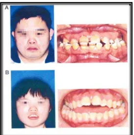 Gambar. 6 Anomali gigi pada penderita Sindroma Down. A. Mikrodonsia dan Peg shaped pada Insisivus lateral kanan