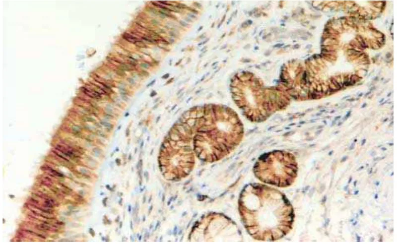 Gambar 2.3.2 Cyclooxygenase-2 ditemukan 3+ pada pewarnaan sitoplasma 