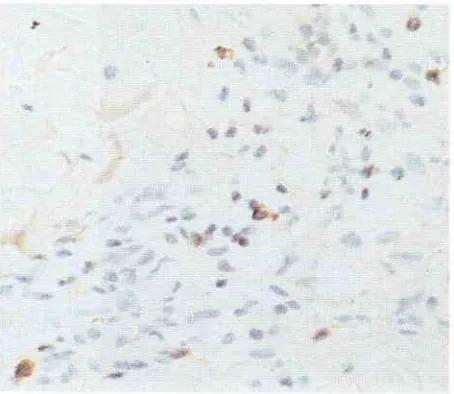 Figure 5. The expression colour), within of UHCL in T cells in an earlylesion of cases No 19