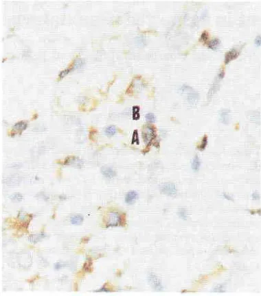 Figure 10. The expression of of Hl,A-DRp monoclonal antibodyin dermal antigen presenting cells (APC) (brownish in colour)an earLy lesion of prurigo Hebra