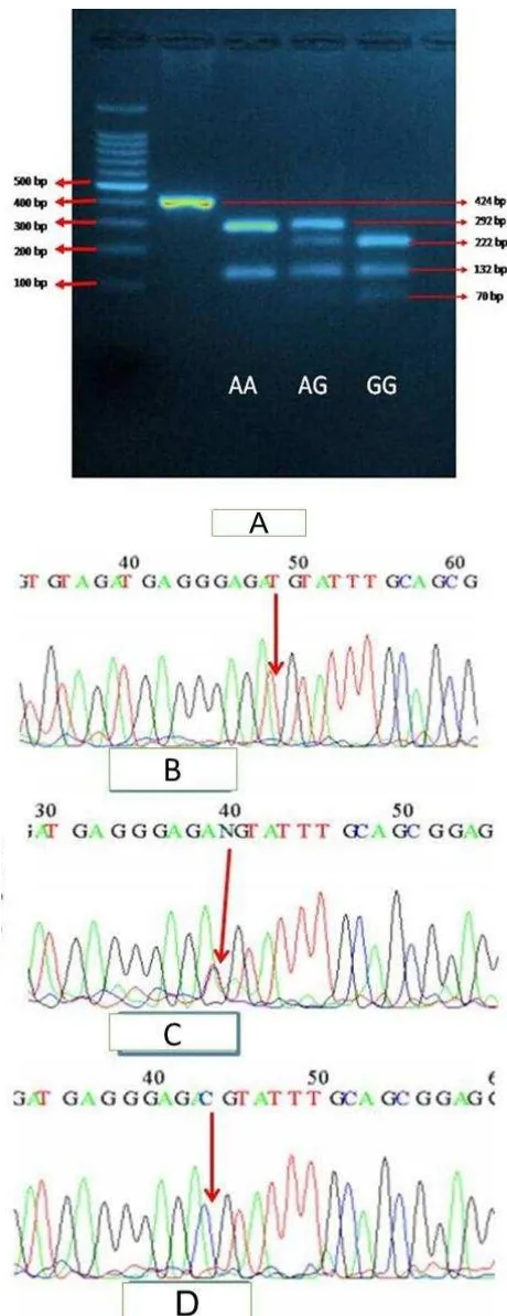 Figure 1. Genotyping result of GSTP1 A313G. Results of PCR-RFLP analysis of glutathion S-transferase P1 polymorphism