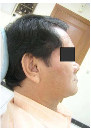 Figure 3. Patient’s appearance in his old upper and   lower denture                                   lower denture