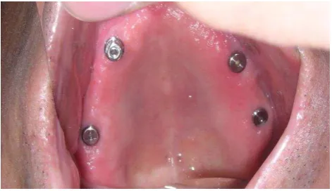 Figure 13.  Patient’s profile in his new upper and       lower denture 