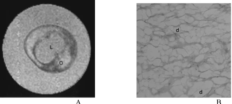 Gambar 6. A. F= fibrous cap                      A                                                                                 B Photomicrograph  menegaskan kehadiran  inti lipid granular  yang luas (panah)  ketebalan disekitar, kepadatan fibrous cap tidak sama dengan lemak (tipe IV-Va plak, klasifikasi AHA )12 