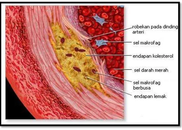 Gambar 10. Potongan melintang arteri yang  mengalami aterosklerosis16 