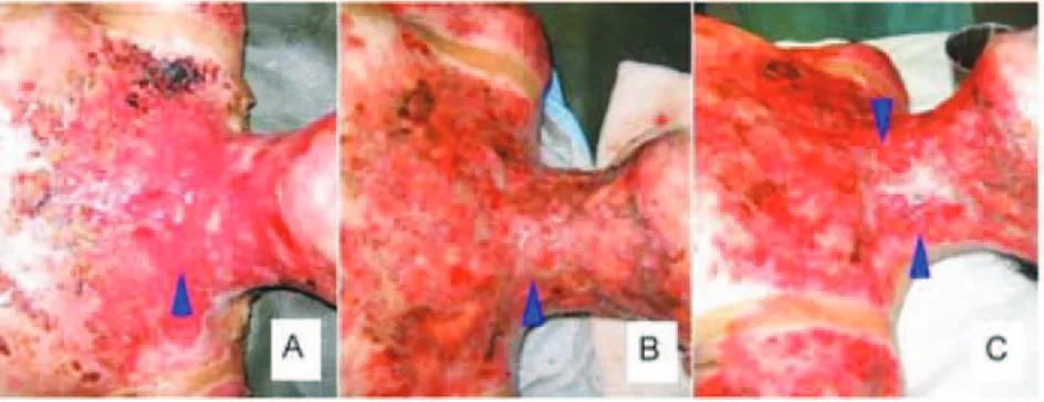 Figure 5. The pictures showing wound in the phase of ibroplasias. A. Unhealthy granulation tissue (arrow indicated) which, exudative is not suitable for graft to take