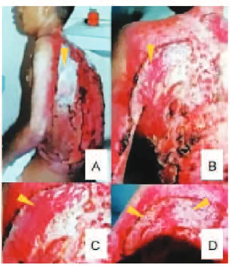 Figure 7. Subject with burn injury (lame) treated with SSD. On day 7 a minimal re-epithelialization (white shaded) was noted (left)