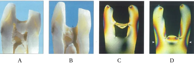 Gambar 1. A. Gigi sebelum pembukaan akses pada perawatan endodontik. B. Gigi setelah pembukaan