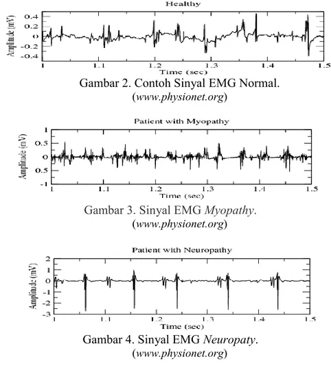 Gambar 2. Contoh Sinyal EMG Normal. 