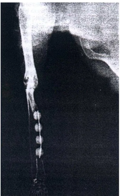 Figure 3. X ray of one of the samples’ left radius with the application of ceftriaxone impregnated beads