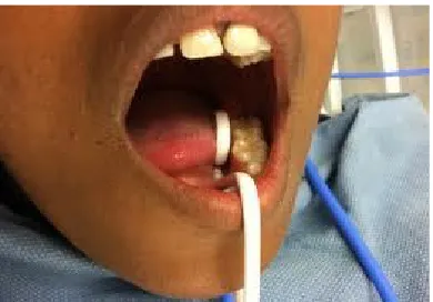 Gambar 1. Saliva ejector