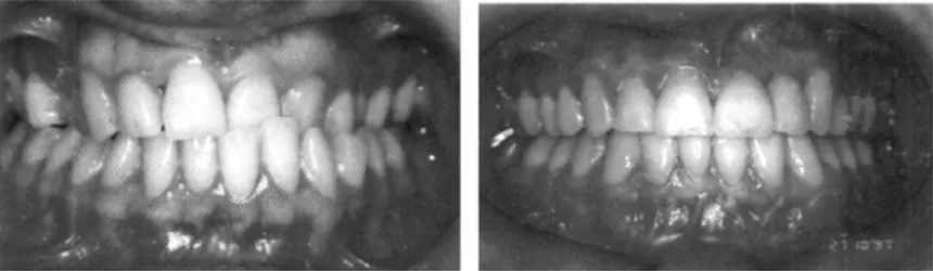 Gambar 1. Foto intraoral sebelum dan setelah perawatan dengan pembukaan ruangan,  agenesis insisif lateral 