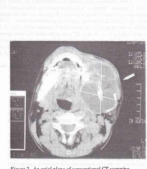 Figure 2. Anaxial plane ofconventional CT scanning