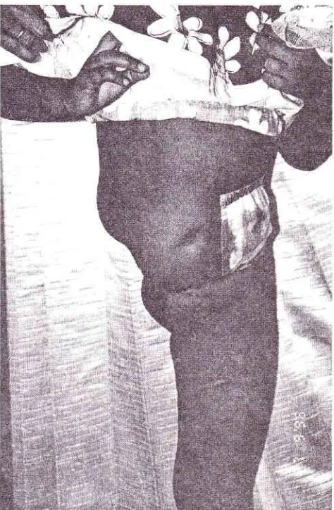 Figure ) . Side view of the patient, covered with cicatrix tissue and a smaLl area of granulation tissue