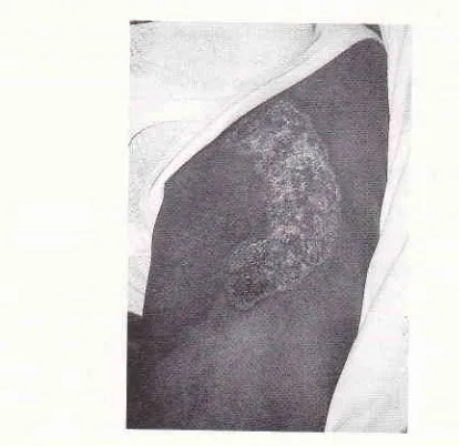Figure 1. 'lwo hyperkeratotic plaques on the dorsurn ofthe rightfoot.