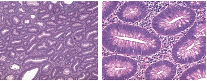 Gambar 4. A. Adenoma tubular dengan struktur tubular padat. B. Inti pada adenoma dengan  displasia ringan menunjukkan inti membesar dan elongasi, inti bertumpuk dengan anak inti nyata,  mitosis sering ditemukan dan musin deplesi