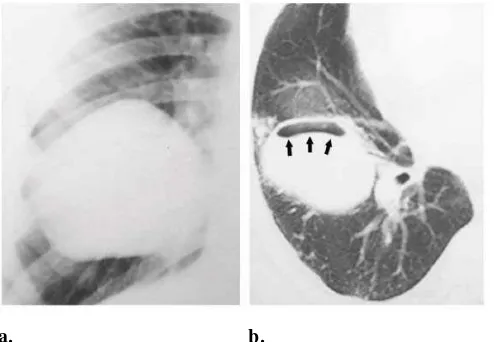 Gambar 3. Gambaran radiologi Echinococcus granulosus (a) tampak kista besar pada kanan bawah paru (b) CT scan menunjukkan gambaran crescent sign (meniscus sign) (tanda panah) (disadur dari referensi 3) 