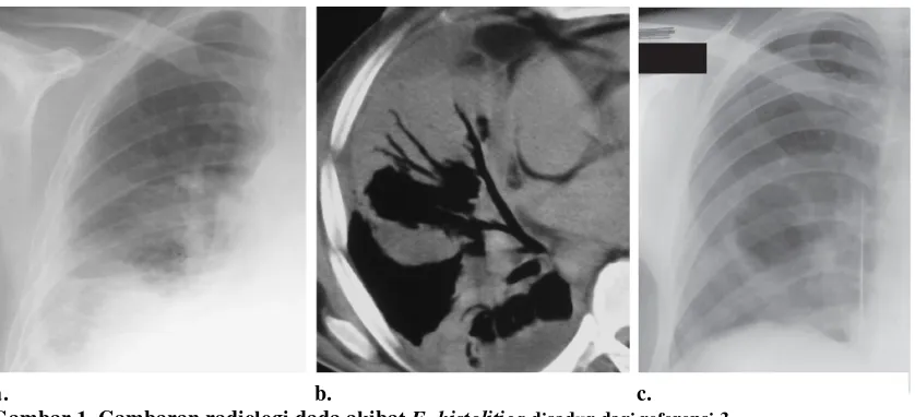 Gambar 1. Gambaran radiologi dada akibat kavitasi (laki-laki, 53 tahun dengan abses hatiinfiltrat basal alveolar paru kanan.(a)   E