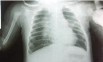 Figure 1: Anteroposterior thorax imaging showed bilateral pneu-monia and no cardiac enlargement.
